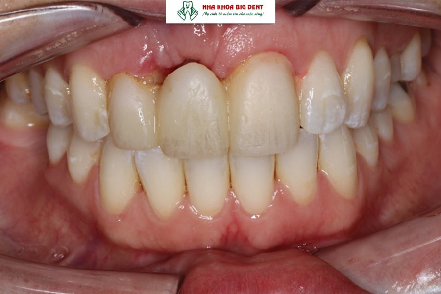 trường hợp không nên niềng răng