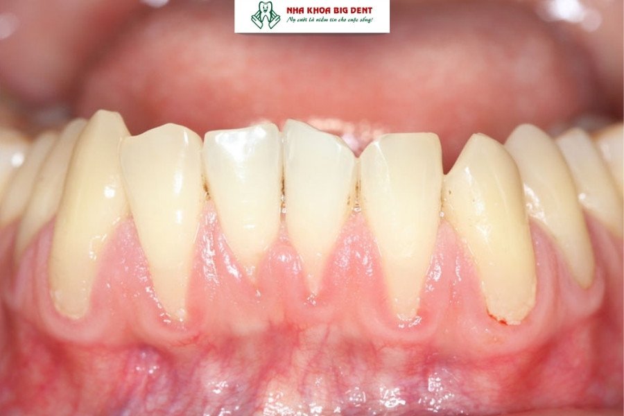 tác hại của niềng răng