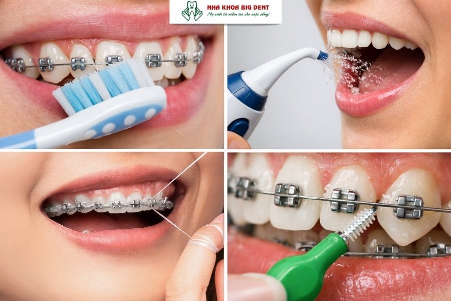 niềng răng có làm răng dài ra không