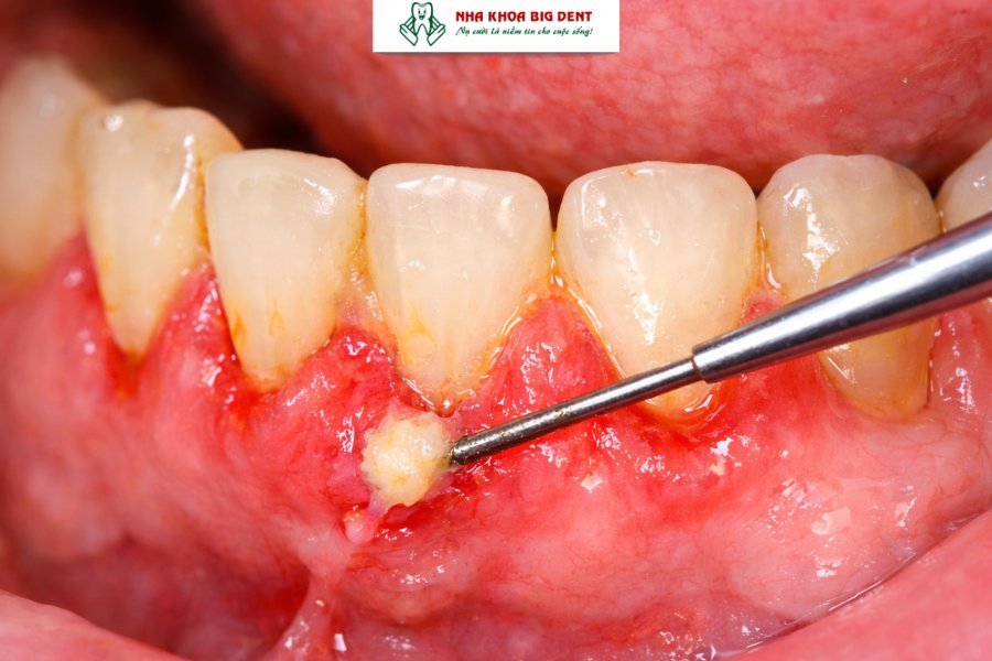 niềng răng có uống bia được không