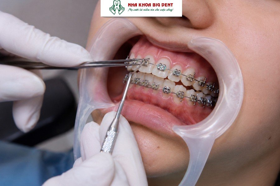 siết răng khi niềng
