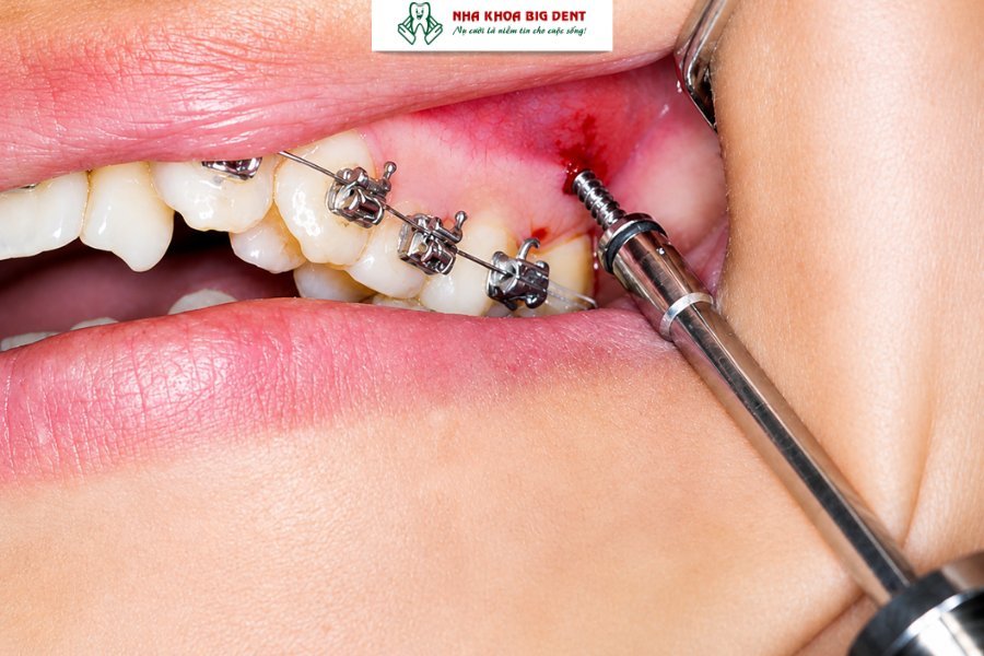 cắm vít niềng răng