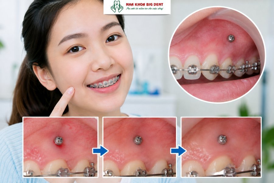 cắm vít niềng răng