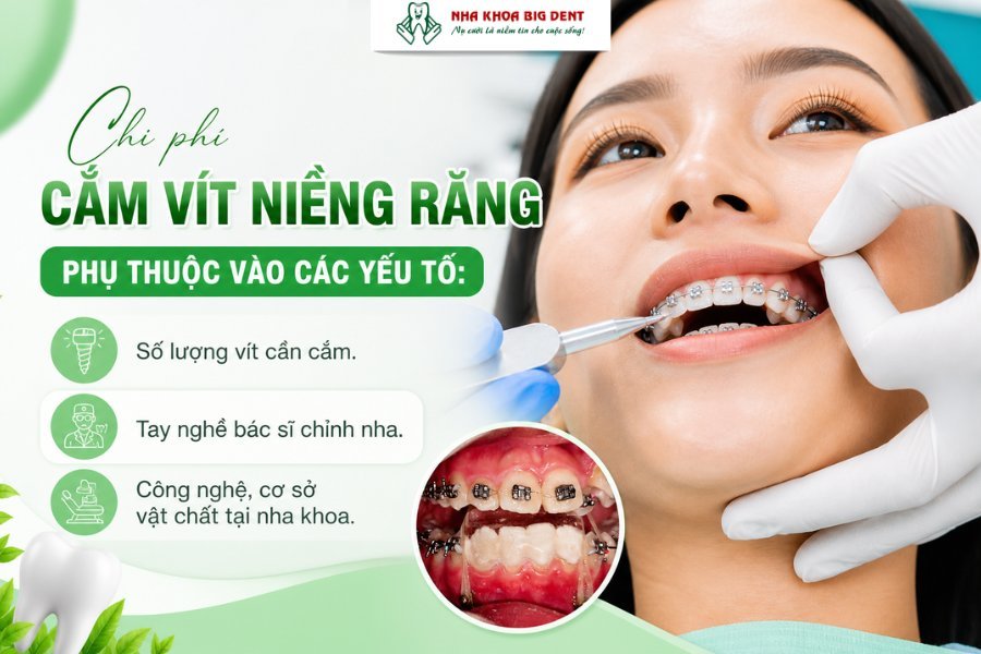 cắm vít niềng răng