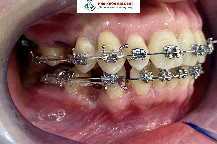 đóng khoảng trong niềng răng
