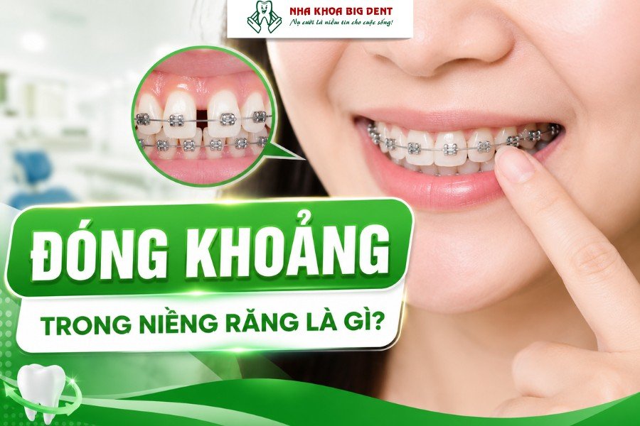 đóng khoảng trong niềng răng
