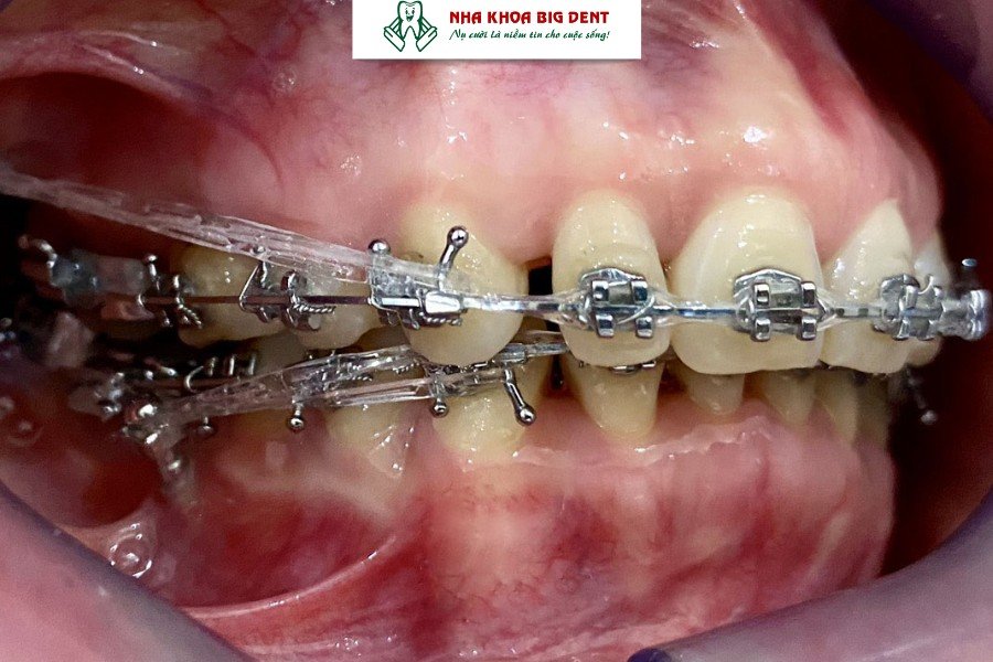 đóng khoảng trong niềng răng