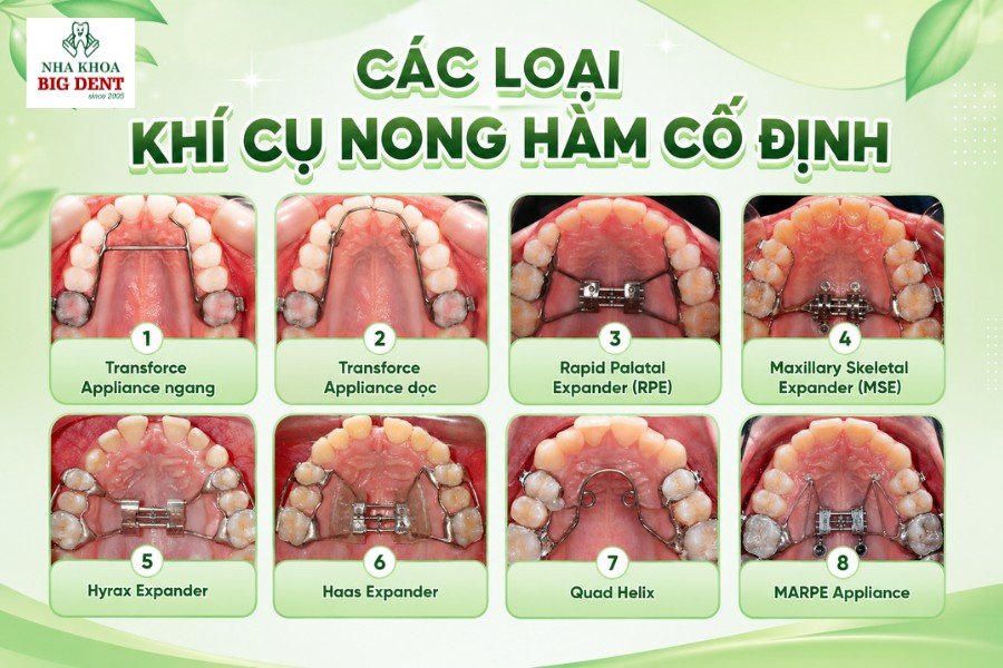 nong hàm niềng răng