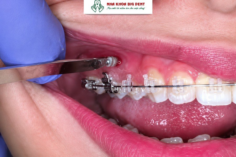 tháo vít niềng răng