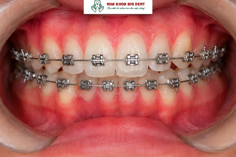 không đeo hàm duy trì sau niềng răng