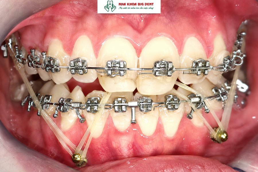 cắm vít niềng răng