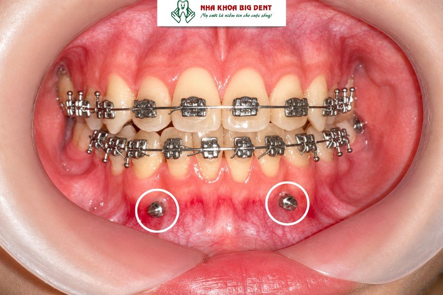 tháo vít niềng răng