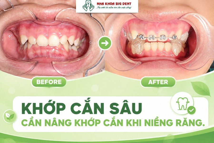 nâng khớp cắn khi niềng răng