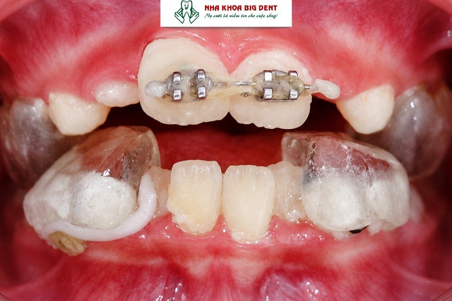 nâng khớp cắn khi niềng răng