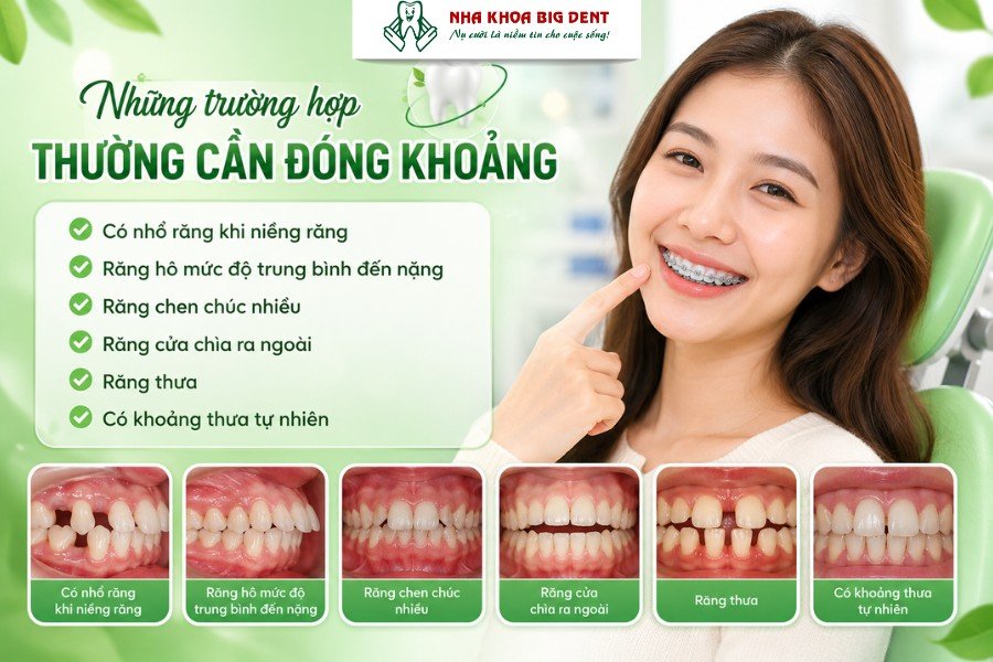 đóng khoảng trong niềng răng