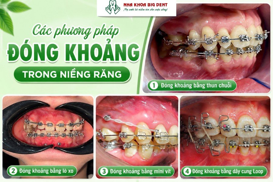 đóng khoảng trong niềng răng