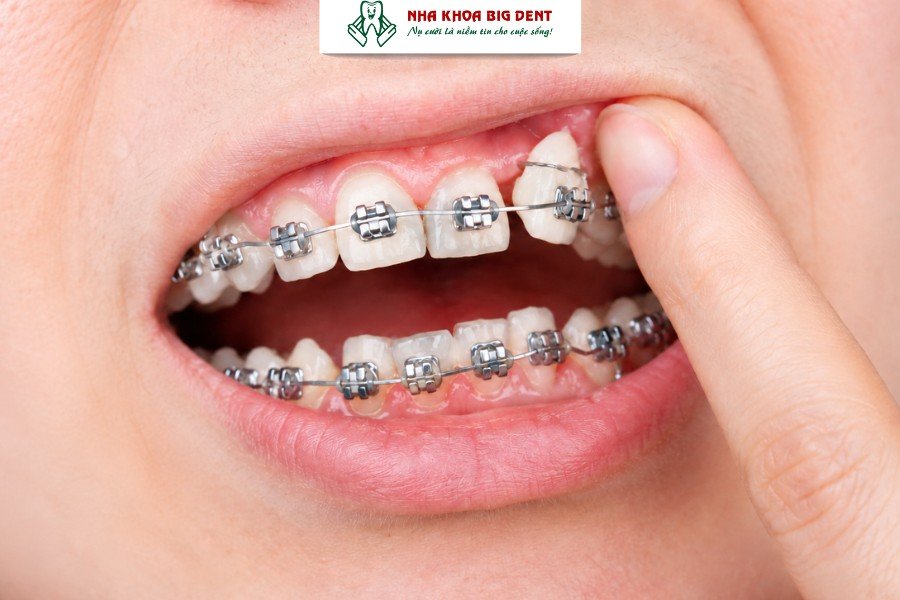 niềng răng có làm răng yếu đi không