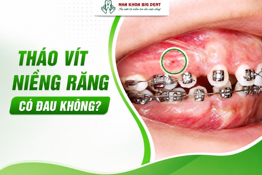 Tháo vít niềng răng