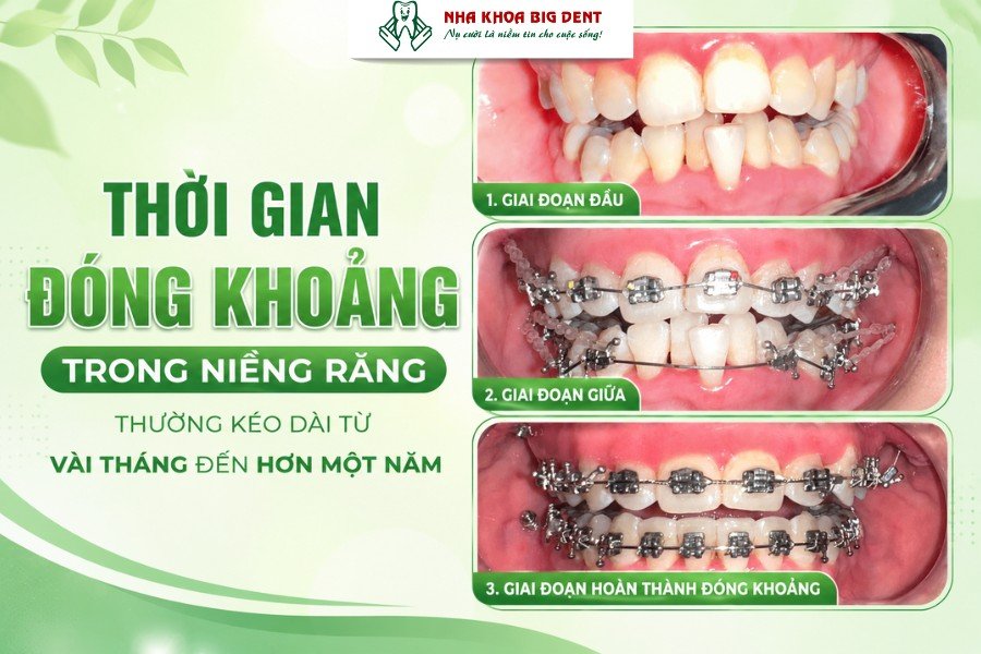 đóng khoảng trong niềng răng