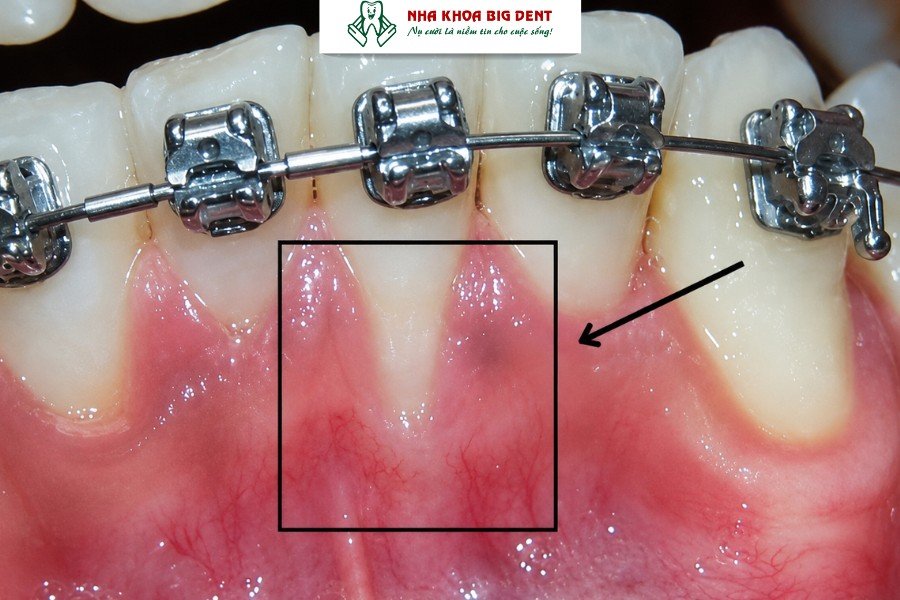 niềng răng có làm răng yếu đi không