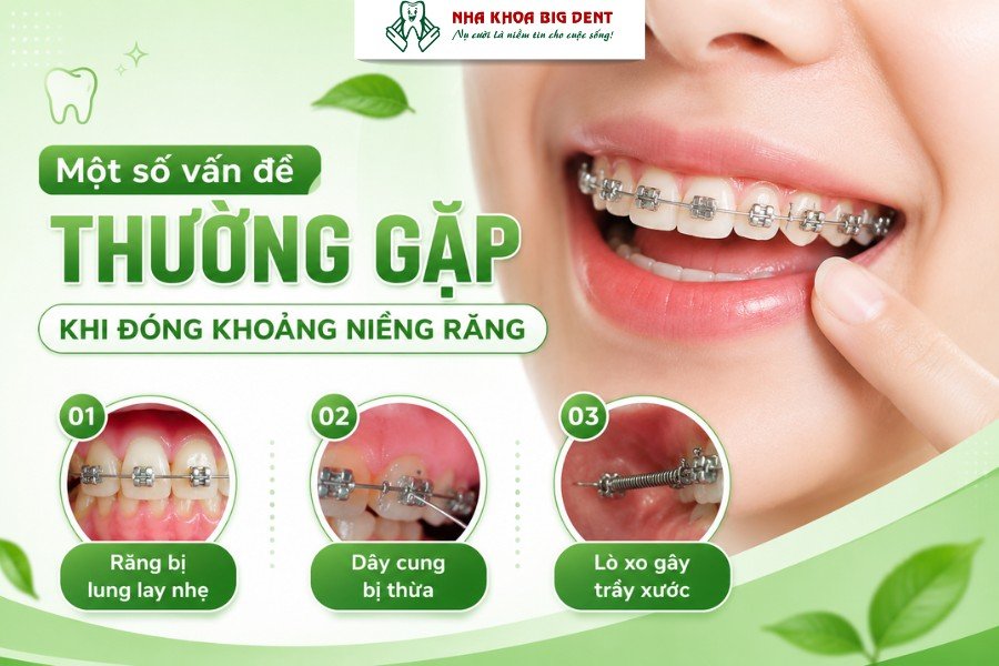 đóng khoảng trong niềng răng