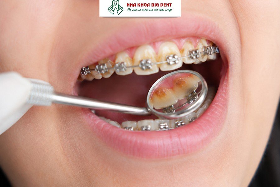 niềng răng có làm răng yếu đi không
