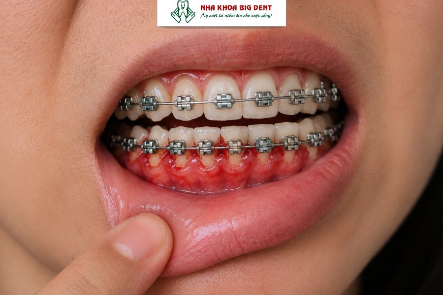 niềng răng có làm răng yếu đi không
