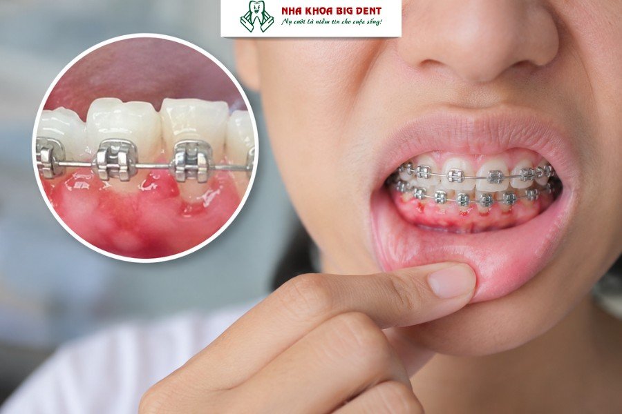 niềng răng có đi bơi được không