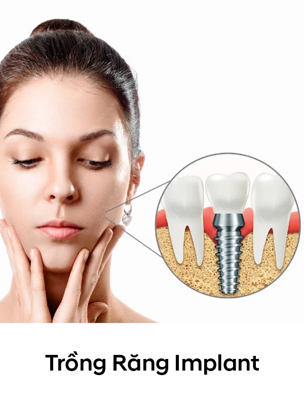 Trồng-răng-implant